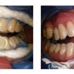 Bělení zubů: jak na bezpečné a efektivní metody pro dokonalý úsměv